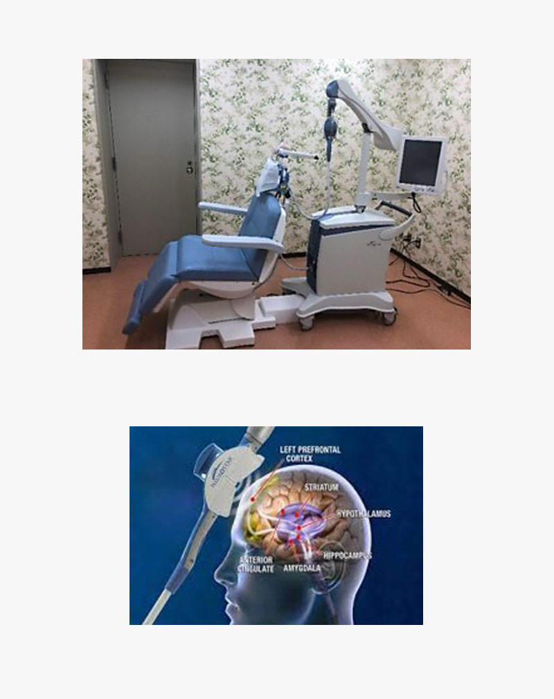 反復経頭蓋磁気刺激療法（rTMS）